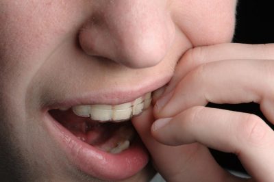 Read more about the article יישור שיניים שקוף – כיצד הוא יכול לשפר את הביטחון העצמי