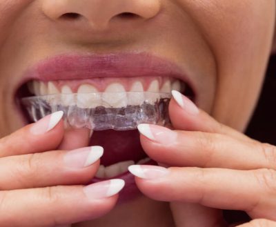 כמה עולה השתלת שיניים בכל הפה